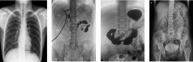 數(shù)字胃腸DR機(jī)造影 數(shù)字胃腸DR機(jī)造影