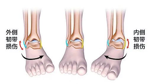 【醫(yī)療科普】之為什么說(shuō)踝關(guān)節(jié)骨折手術(shù)復(fù)雜？