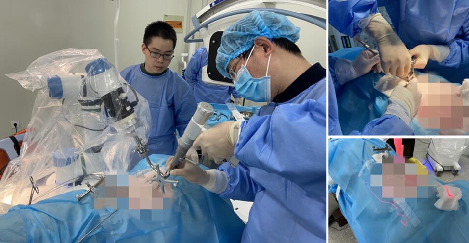 骨科手術(shù)機器人手術(shù)創(chuàng)面小 骨科手術(shù)機器人手術(shù)創(chuàng)面小