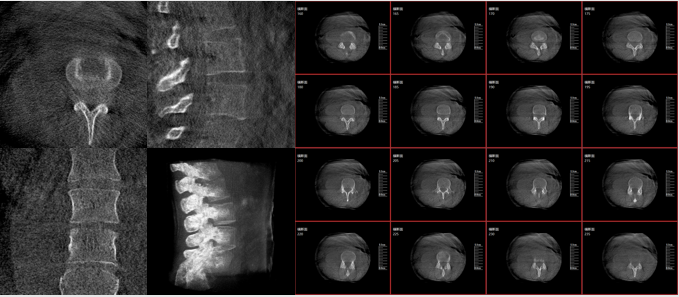 術(shù)中三維C臂的優(yōu)勢:三維影像功能 術(shù)中三維C臂的優(yōu)勢:三維影像功能