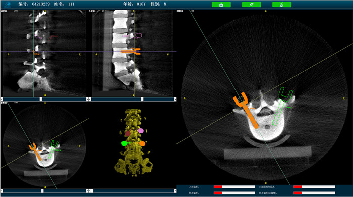 機(jī)器人手術(shù)系統(tǒng)3D影像 機(jī)器人手術(shù)系統(tǒng)3D影像