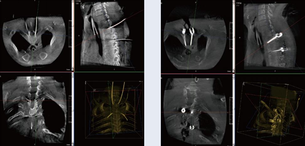 三維C臂與骨科導(dǎo)航機(jī)器人配合應(yīng)用(助力骨科手術(shù)更準(zhǔn)確) 三維C臂與骨科導(dǎo)航機(jī)器人配合應(yīng)用(助力骨科手術(shù)更準(zhǔn)確)
