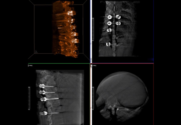 術(shù)中三維導(dǎo)航C臂影像 術(shù)中三維導(dǎo)航C臂影像