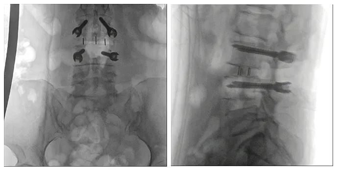 術(shù)中三維導(dǎo)航C臂影像 術(shù)中三維導(dǎo)航C臂影像