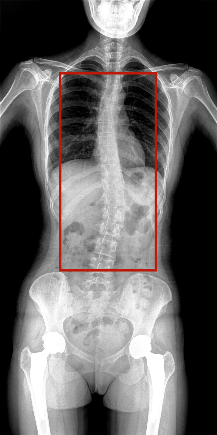 全脊柱動(dòng)態(tài)DR圖像 全脊柱動(dòng)態(tài)DR圖像