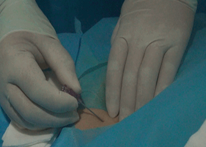 介入治療 介入治療