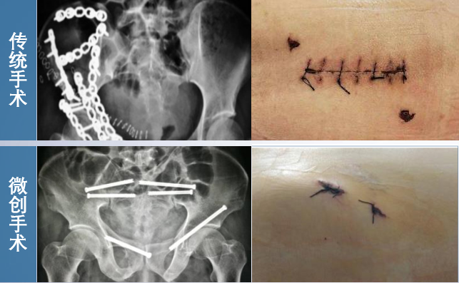 骨科機器人微創(chuàng)手術(shù) 骨科機器人微創(chuàng)手術(shù)