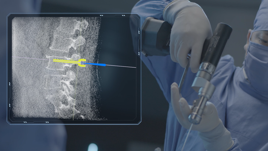 骨科機器人 骨科機器人