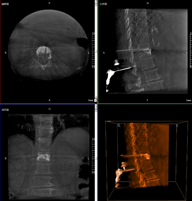 骨科機(jī)器人影像
