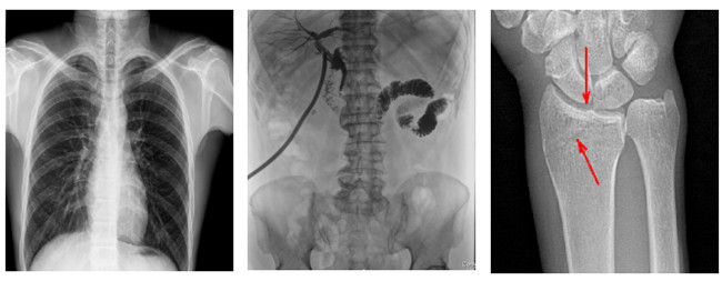 懸吊動(dòng)態(tài)DR臨床圖像 懸吊動(dòng)態(tài)DR臨床圖像