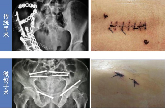 脊柱外科手術(shù)導航定位系統(tǒng)的微創(chuàng)手術(shù)