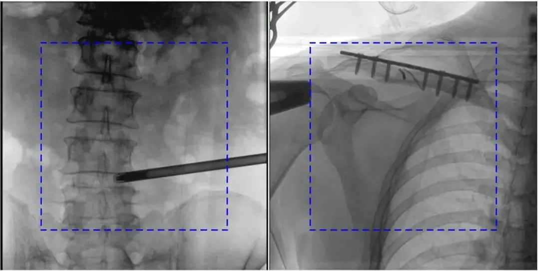C臂機(jī)圖像不清楚