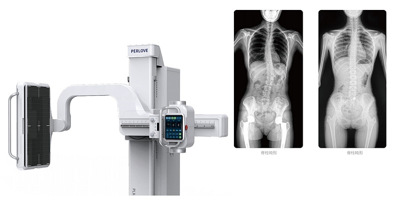 動態(tài)DR脊柱拍片
