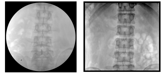 移動(dòng)式平板C形臂X射線(xiàn)機(jī)腰椎圖像