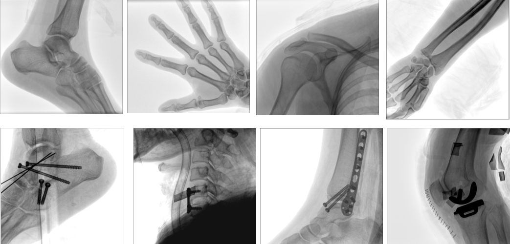 移動(dòng)式平板C形臂X射線(xiàn)機(jī)臨床影像
